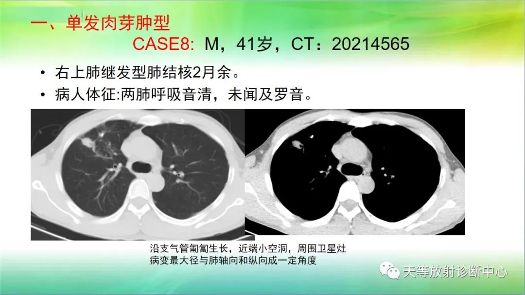 影像PPT - 【PPT】肺结核肉芽肿性影像学诊断与鉴别诊断-16 影像PPT - 【PPT】肺结核肉芽肿性影像学诊断与鉴别诊断-16