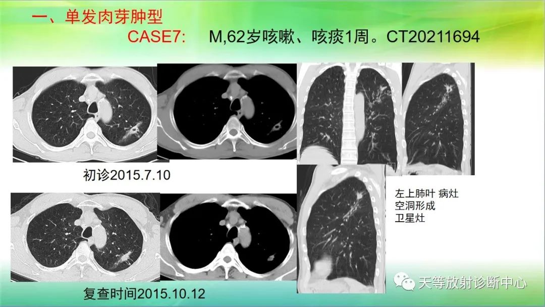 影像PPT - 【PPT】肺结核肉芽肿性影像学诊断与鉴别诊断-15 影像PPT - 【PPT】肺结核肉芽肿性影像学诊断与鉴别诊断-15