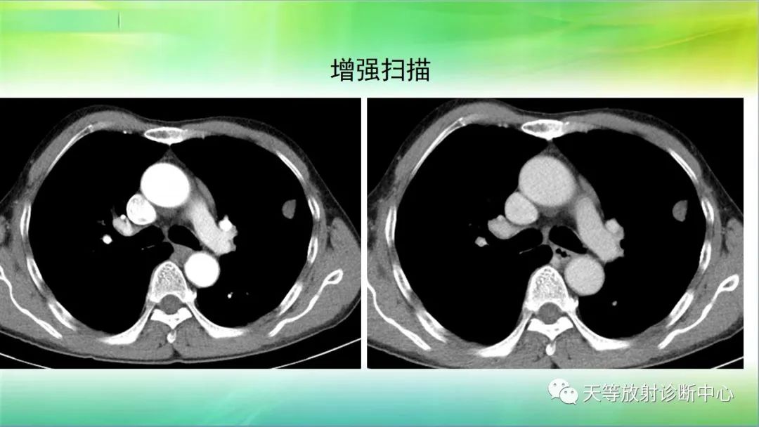影像PPT - 【PPT】肺结核肉芽肿性影像学诊断与鉴别诊断-23 影像PPT - 【PPT】肺结核肉芽肿性影像学诊断与鉴别诊断-23