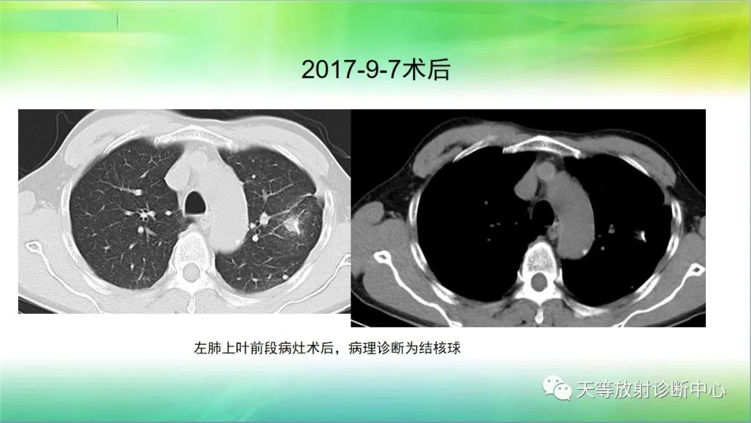 影像PPT - 【PPT】肺结核肉芽肿性影像学诊断与鉴别诊断-24 影像PPT - 【PPT】肺结核肉芽肿性影像学诊断与鉴别诊断-24