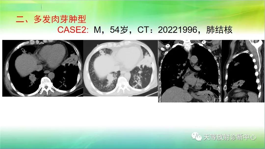 影像PPT - 【PPT】肺结核肉芽肿性影像学诊断与鉴别诊断-26 影像PPT - 【PPT】肺结核肉芽肿性影像学诊断与鉴别诊断-26