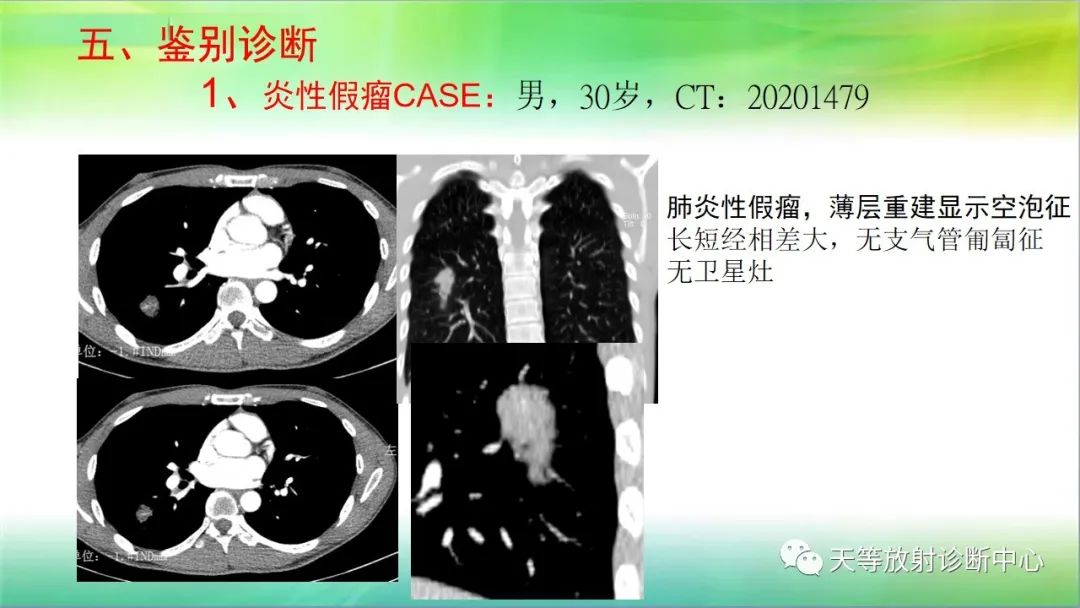 影像PPT - 【PPT】肺结核肉芽肿性影像学诊断与鉴别诊断-31 影像PPT - 【PPT】肺结核肉芽肿性影像学诊断与鉴别诊断-31