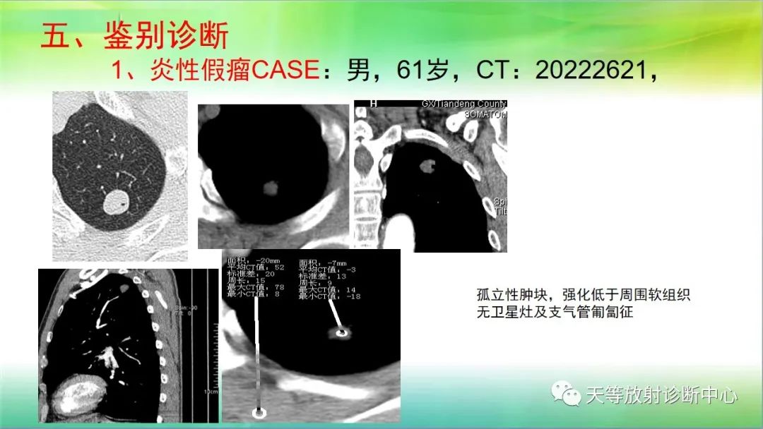 影像PPT - 【PPT】肺结核肉芽肿性影像学诊断与鉴别诊断-32 影像PPT - 【PPT】肺结核肉芽肿性影像学诊断与鉴别诊断-32