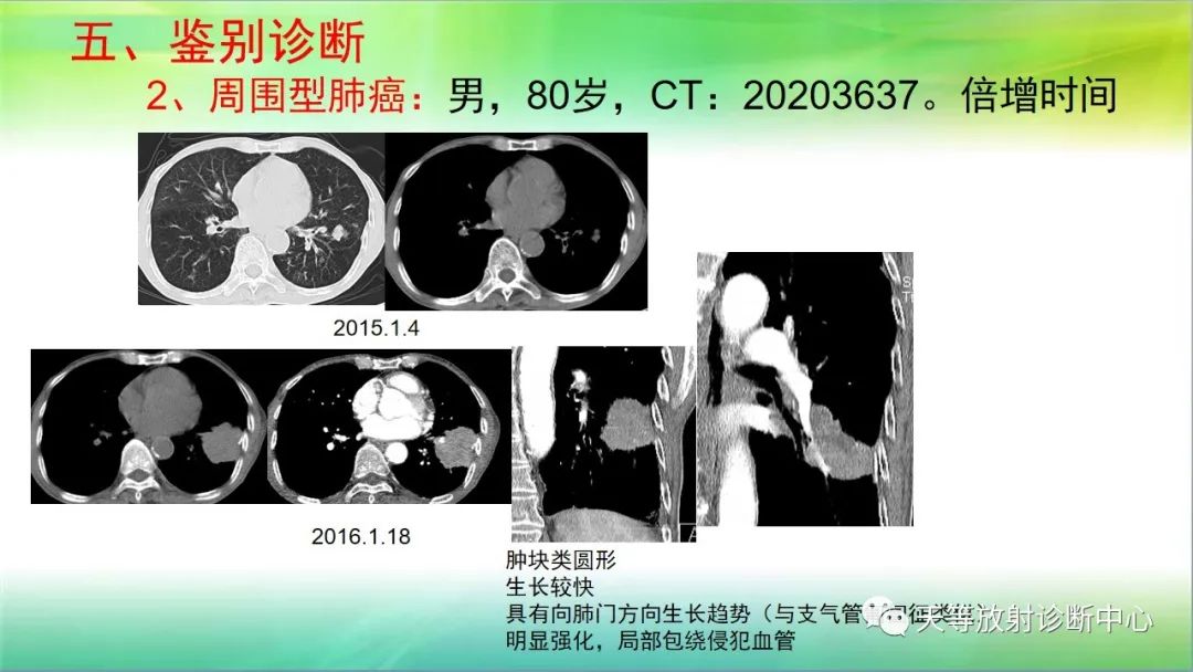 影像PPT - 【PPT】肺结核肉芽肿性影像学诊断与鉴别诊断-35 影像PPT - 【PPT】肺结核肉芽肿性影像学诊断与鉴别诊断-35
