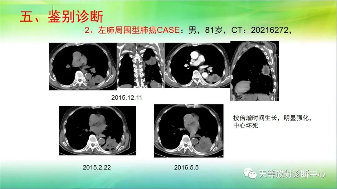 影像PPT - 【PPT】肺结核肉芽肿性影像学诊断与鉴别诊断-36 影像PPT - 【PPT】肺结核肉芽肿性影像学诊断与鉴别诊断-36