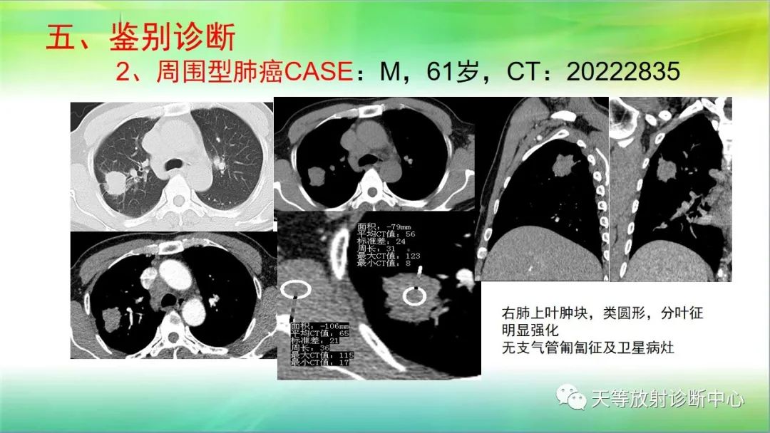 影像PPT - 【PPT】肺结核肉芽肿性影像学诊断与鉴别诊断-37 影像PPT - 【PPT】肺结核肉芽肿性影像学诊断与鉴别诊断-37