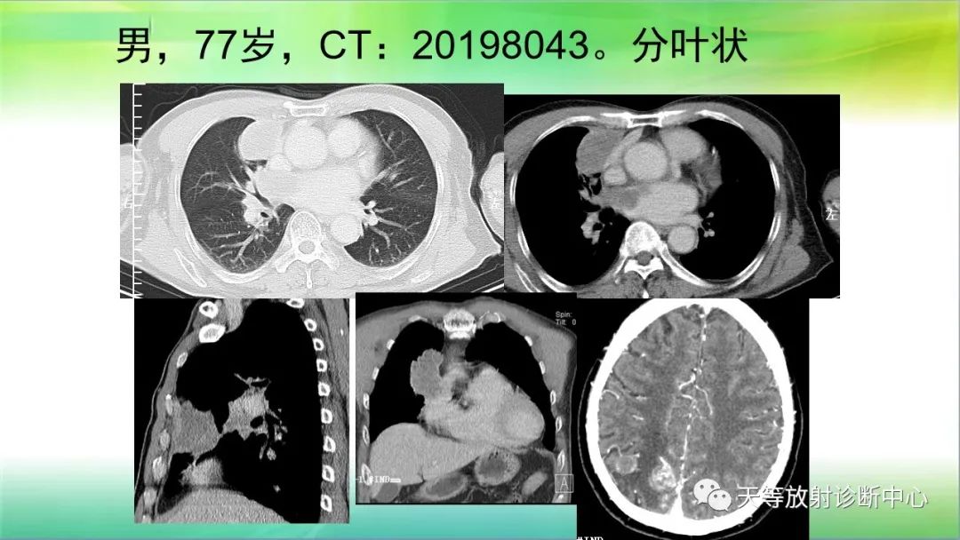 影像PPT - 【PPT】肺结核肉芽肿性影像学诊断与鉴别诊断-38 影像PPT - 【PPT】肺结核肉芽肿性影像学诊断与鉴别诊断-38
