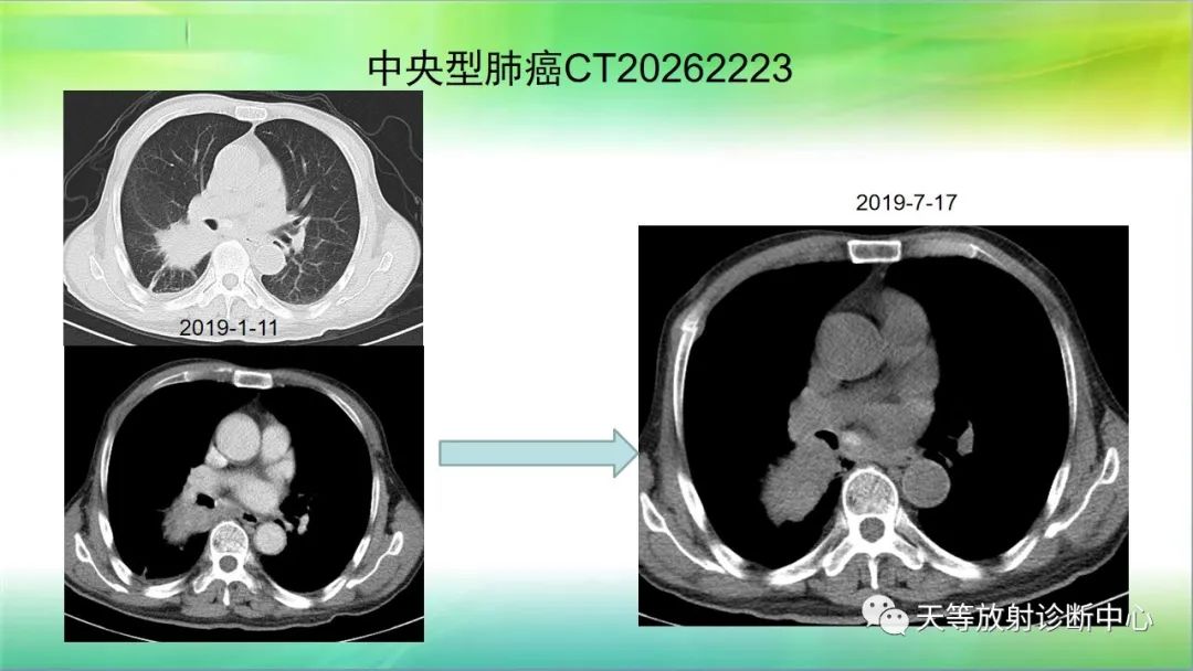 影像PPT - 【PPT】肺结核肉芽肿性影像学诊断与鉴别诊断-39 影像PPT - 【PPT】肺结核肉芽肿性影像学诊断与鉴别诊断-39