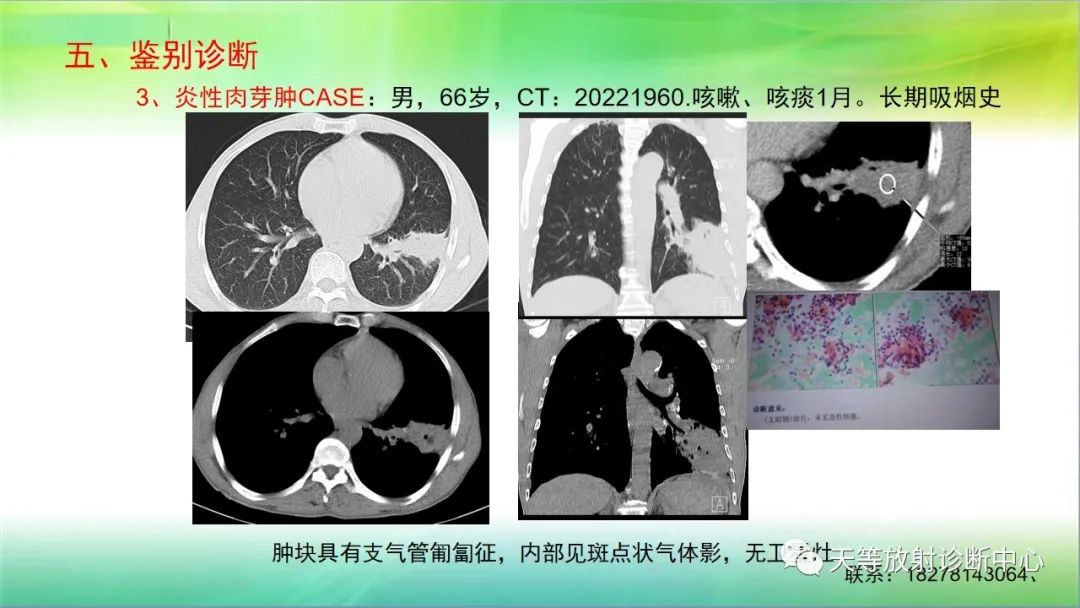 影像PPT - 【PPT】肺结核肉芽肿性影像学诊断与鉴别诊断-40 影像PPT - 【PPT】肺结核肉芽肿性影像学诊断与鉴别诊断-40