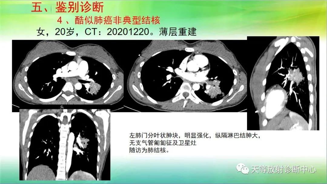 影像PPT - 【PPT】肺结核肉芽肿性影像学诊断与鉴别诊断-41 影像PPT - 【PPT】肺结核肉芽肿性影像学诊断与鉴别诊断-41