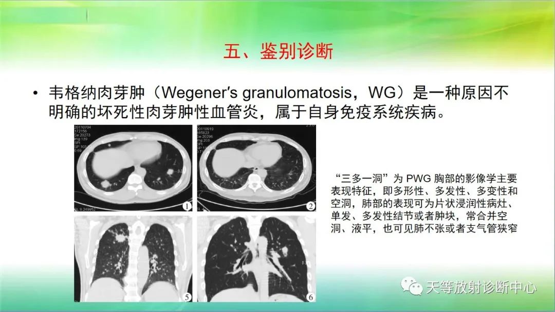 影像PPT - 【PPT】肺结核肉芽肿性影像学诊断与鉴别诊断-42 影像PPT - 【PPT】肺结核肉芽肿性影像学诊断与鉴别诊断-42