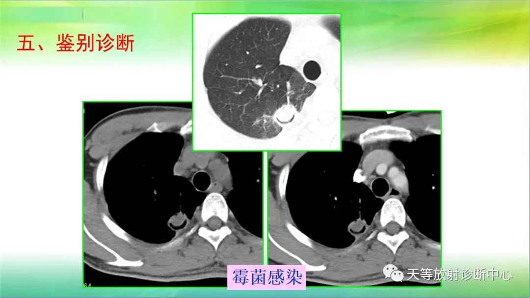影像PPT - 【PPT】肺结核肉芽肿性影像学诊断与鉴别诊断-43 影像PPT - 【PPT】肺结核肉芽肿性影像学诊断与鉴别诊断-43