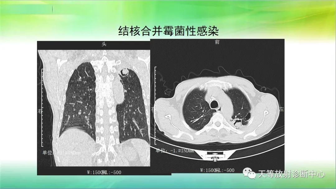 影像PPT - 【PPT】肺结核肉芽肿性影像学诊断与鉴别诊断-44 影像PPT - 【PPT】肺结核肉芽肿性影像学诊断与鉴别诊断-44