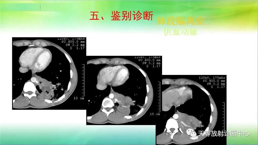 影像PPT - 【PPT】肺结核肉芽肿性影像学诊断与鉴别诊断-45 影像PPT - 【PPT】肺结核肉芽肿性影像学诊断与鉴别诊断-45