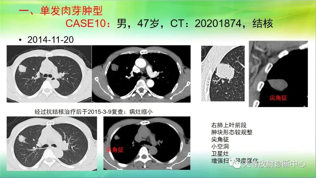 影像PPT - 【PPT】肺结核肉芽肿性影像学诊断与鉴别诊断-5 影像PPT - 【PPT】肺结核肉芽肿性影像学诊断与鉴别诊断-5