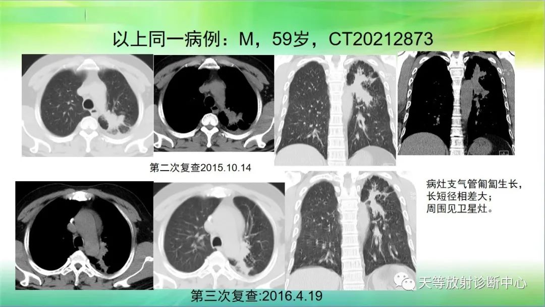影像PPT - 【PPT】肺结核肉芽肿性影像学诊断与鉴别诊断-4 影像PPT - 【PPT】肺结核肉芽肿性影像学诊断与鉴别诊断-4