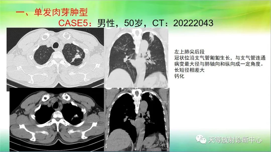 影像PPT - 【PPT】肺结核肉芽肿性影像学诊断与鉴别诊断-2 影像PPT - 【PPT】肺结核肉芽肿性影像学诊断与鉴别诊断-2