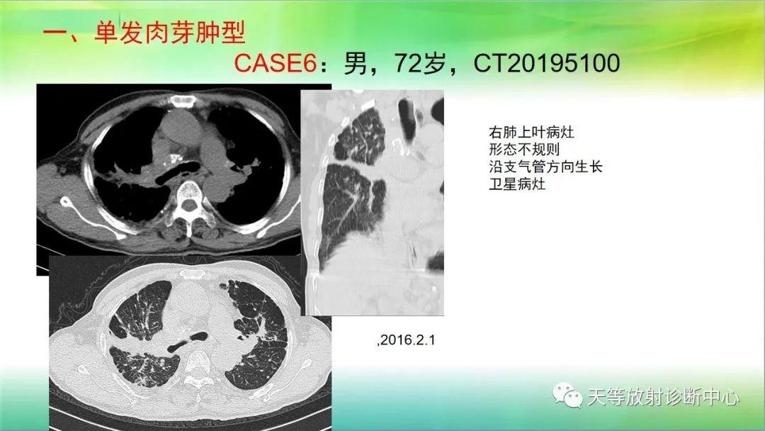 影像PPT - 【PPT】肺结核肉芽肿性影像学诊断与鉴别诊断-3 影像PPT - 【PPT】肺结核肉芽肿性影像学诊断与鉴别诊断-3