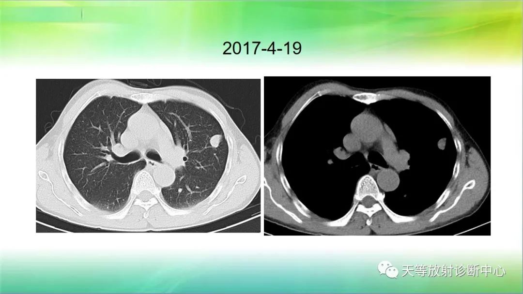 影像PPT - 【PPT】肺结核肉芽肿性影像学诊断与鉴别诊断-6 影像PPT - 【PPT】肺结核肉芽肿性影像学诊断与鉴别诊断-6