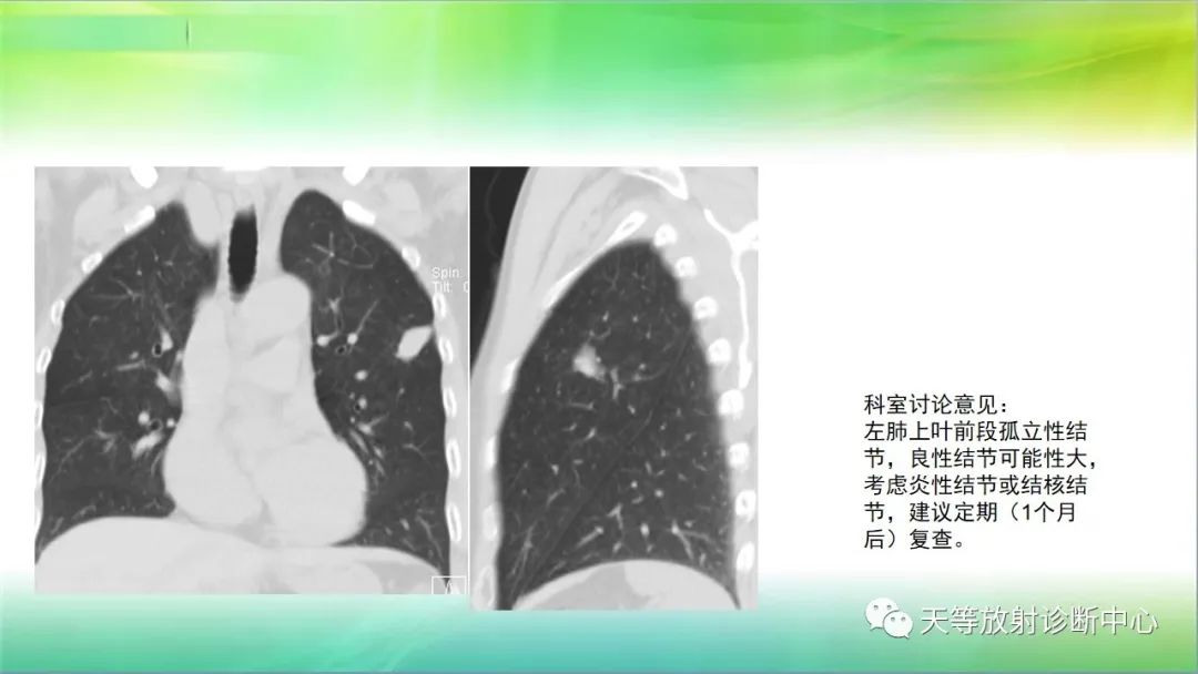 影像PPT - 【PPT】肺结核肉芽肿性影像学诊断与鉴别诊断-7 影像PPT - 【PPT】肺结核肉芽肿性影像学诊断与鉴别诊断-7