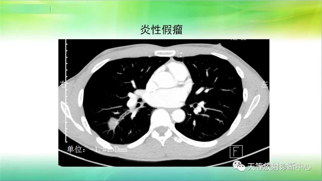影像PPT - 【PPT】肺结核肉芽肿性影像学诊断与鉴别诊断-12 影像PPT - 【PPT】肺结核肉芽肿性影像学诊断与鉴别诊断-12