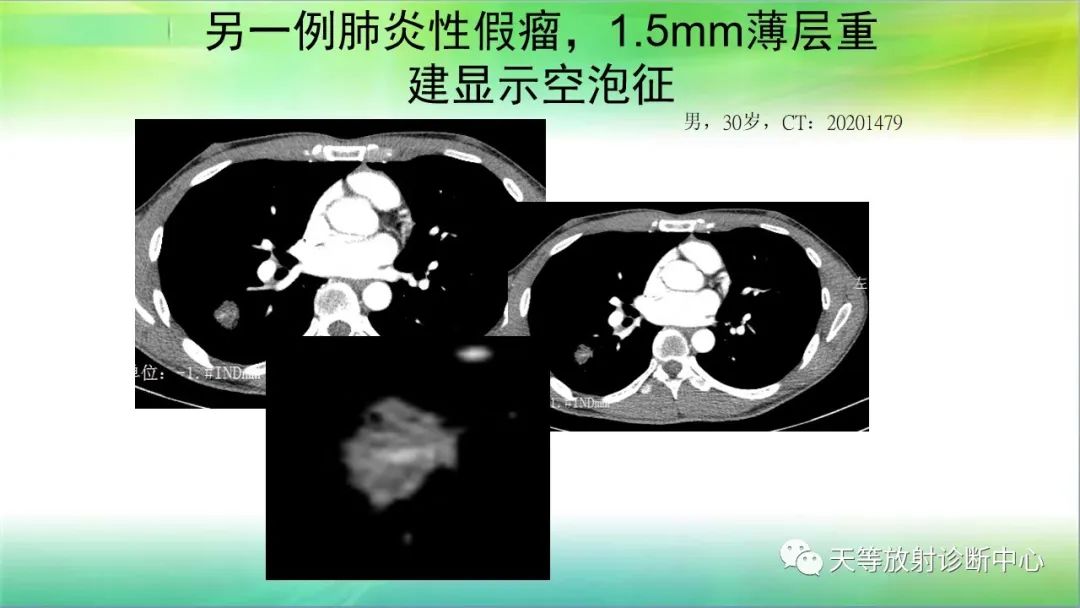 影像PPT - 【PPT】肺结核肉芽肿性影像学诊断与鉴别诊断-11 影像PPT - 【PPT】肺结核肉芽肿性影像学诊断与鉴别诊断-11