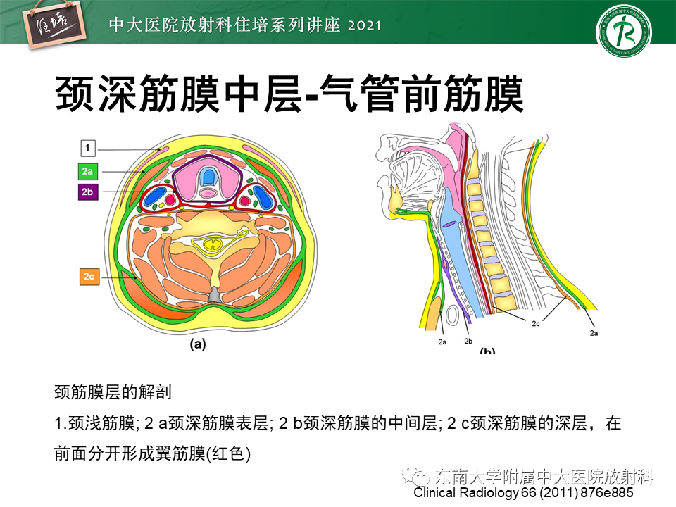 影像PPT - 【PPT】颈部感染的影像诊断及蔓延途径-13