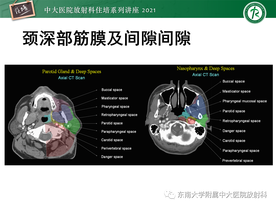 影像PPT - 【PPT】颈部感染的影像诊断及蔓延途径-18