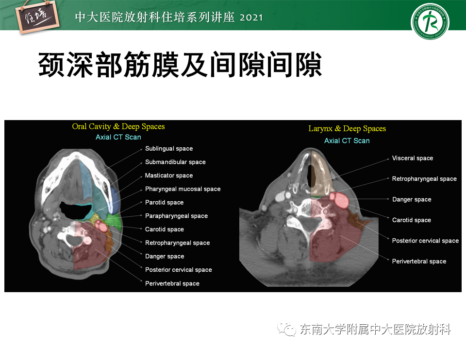 影像PPT - 【PPT】颈部感染的影像诊断及蔓延途径-19