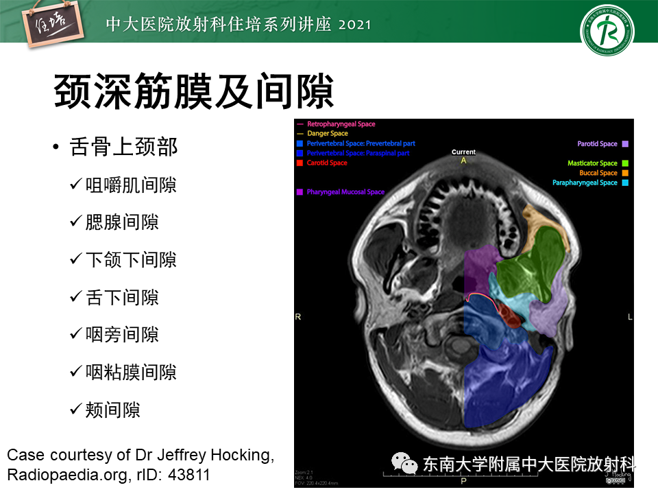 影像PPT - 【PPT】颈部感染的影像诊断及蔓延途径-20