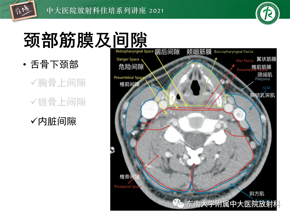 影像PPT - 【PPT】颈部感染的影像诊断及蔓延途径-23