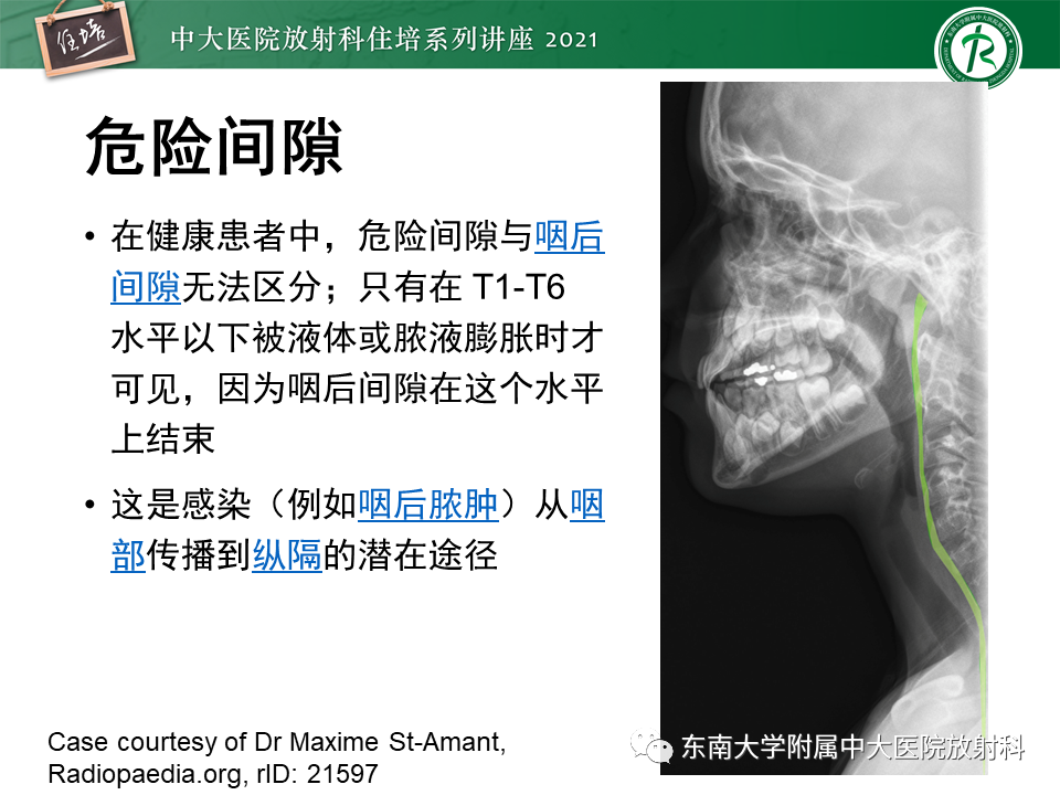 影像PPT - 【PPT】颈部感染的影像诊断及蔓延途径-25