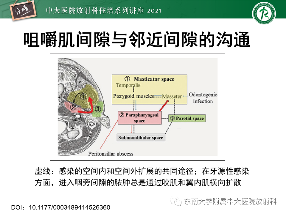 影像PPT - 【PPT】颈部感染的影像诊断及蔓延途径-28