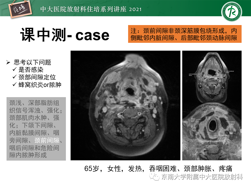 影像PPT - 【PPT】颈部感染的影像诊断及蔓延途径-30