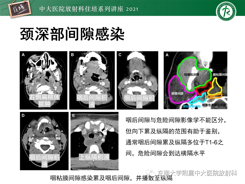 影像PPT - 【PPT】颈部感染的影像诊断及蔓延途径-29