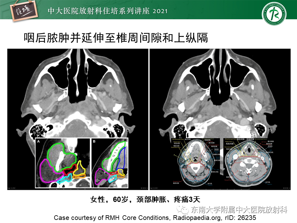 影像PPT - 【PPT】颈部感染的影像诊断及蔓延途径-31