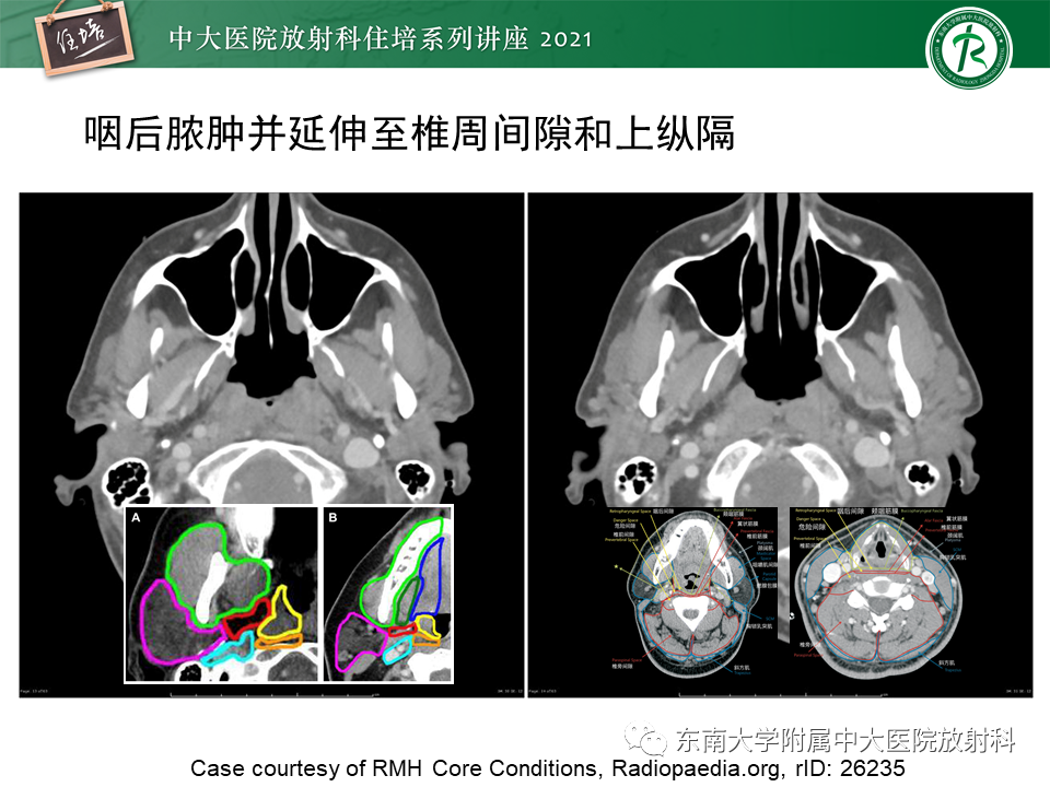 影像PPT - 【PPT】颈部感染的影像诊断及蔓延途径-32