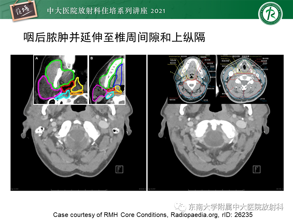 影像PPT - 【PPT】颈部感染的影像诊断及蔓延途径-33