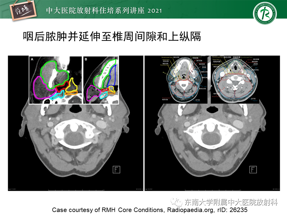 影像PPT - 【PPT】颈部感染的影像诊断及蔓延途径-34