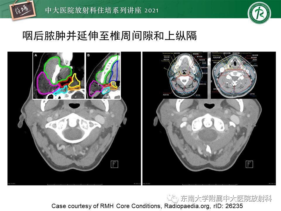 影像PPT - 【PPT】颈部感染的影像诊断及蔓延途径-35