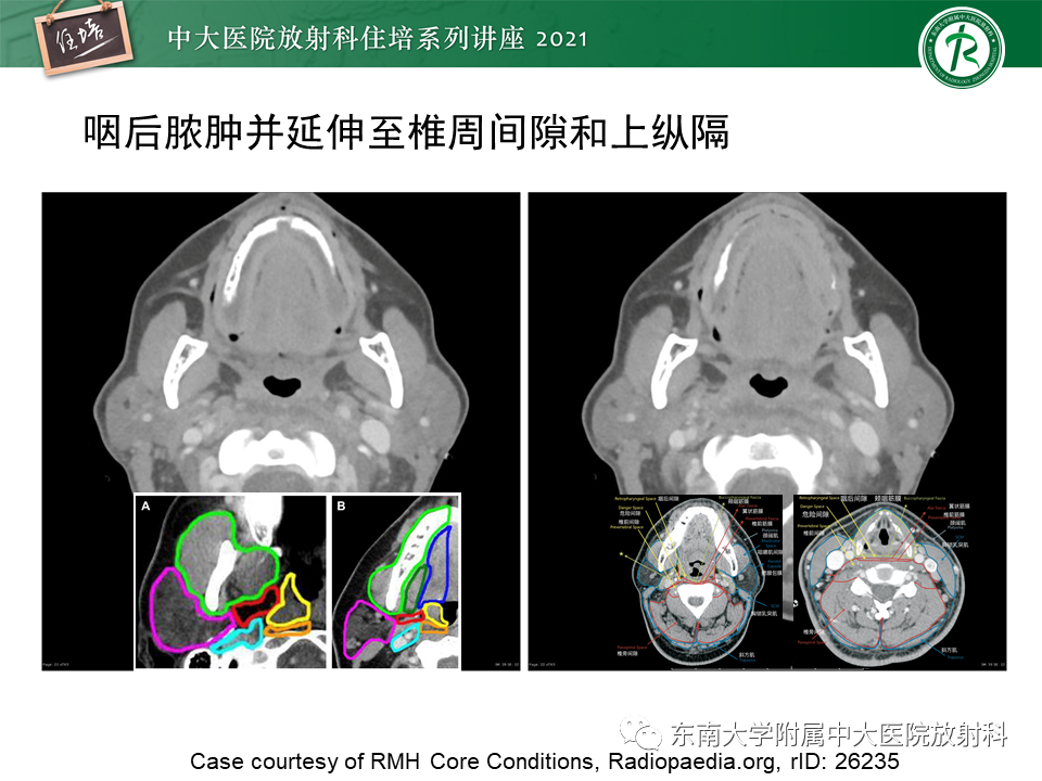 影像PPT - 【PPT】颈部感染的影像诊断及蔓延途径-36