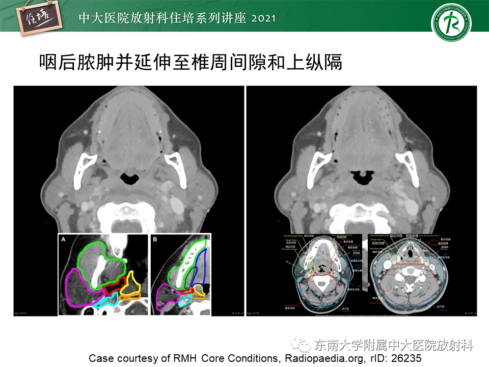 影像PPT - 【PPT】颈部感染的影像诊断及蔓延途径-37