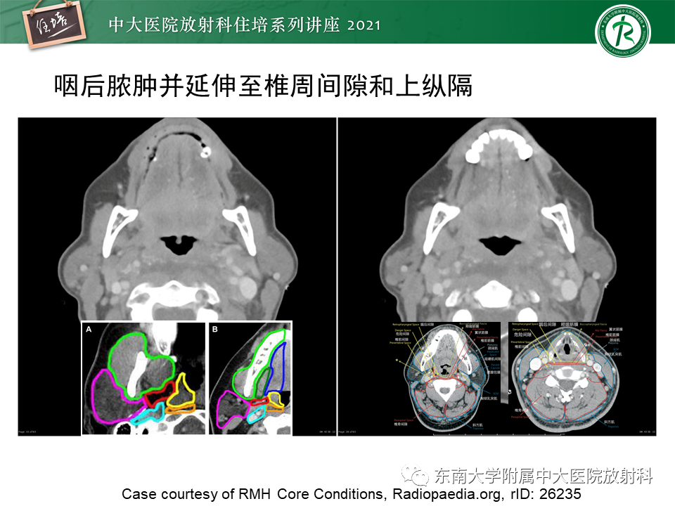 影像PPT - 【PPT】颈部感染的影像诊断及蔓延途径-38