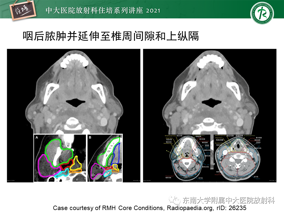 影像PPT - 【PPT】颈部感染的影像诊断及蔓延途径-39