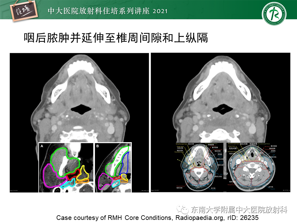 影像PPT - 【PPT】颈部感染的影像诊断及蔓延途径-40