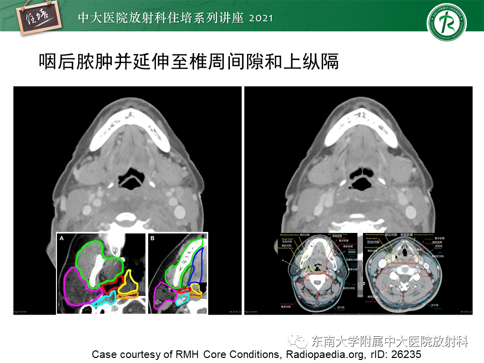 影像PPT - 【PPT】颈部感染的影像诊断及蔓延途径-42