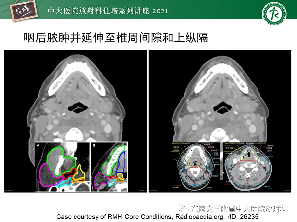 影像PPT - 【PPT】颈部感染的影像诊断及蔓延途径-41