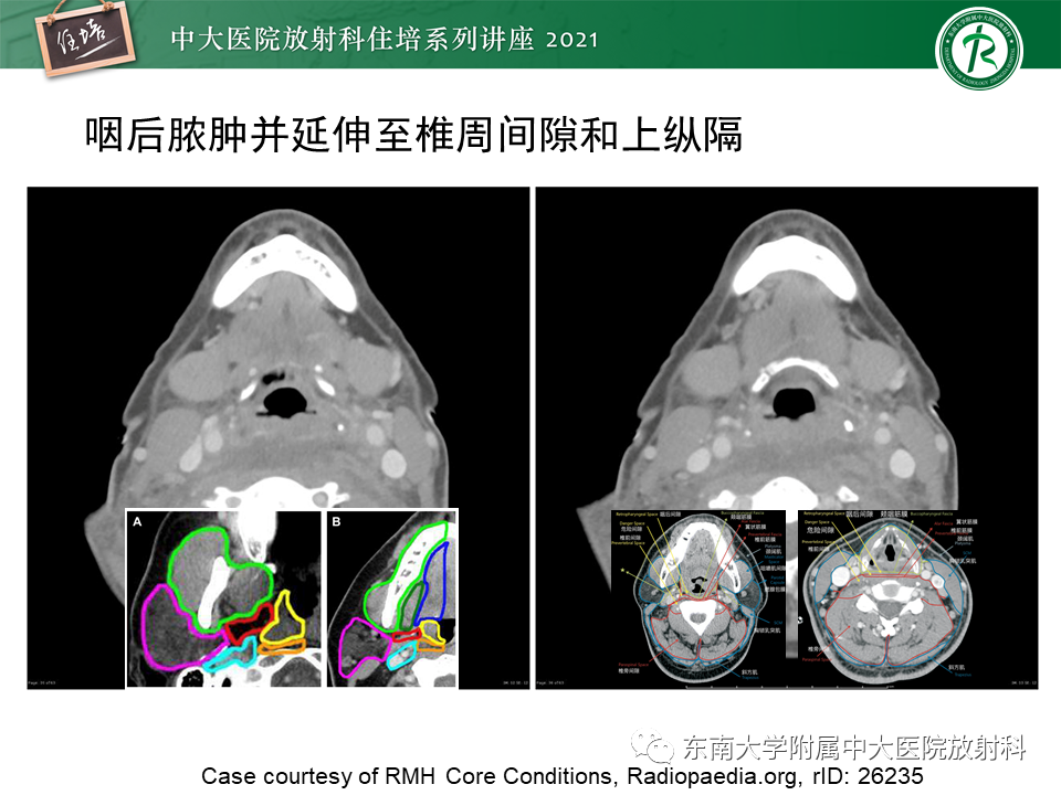 影像PPT - 【PPT】颈部感染的影像诊断及蔓延途径-43