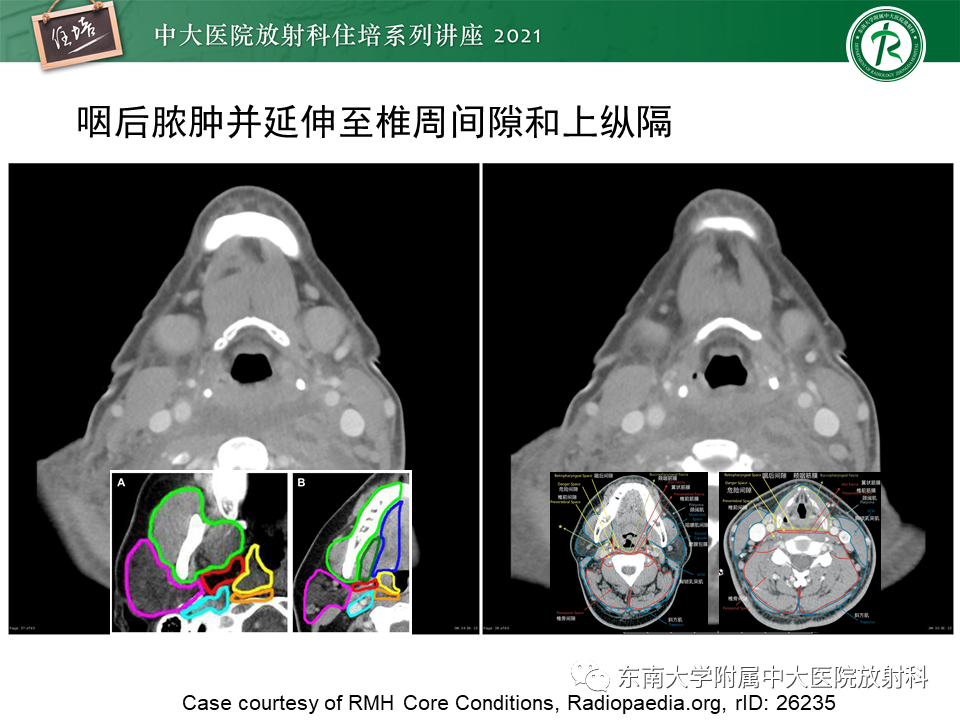 影像PPT - 【PPT】颈部感染的影像诊断及蔓延途径-44