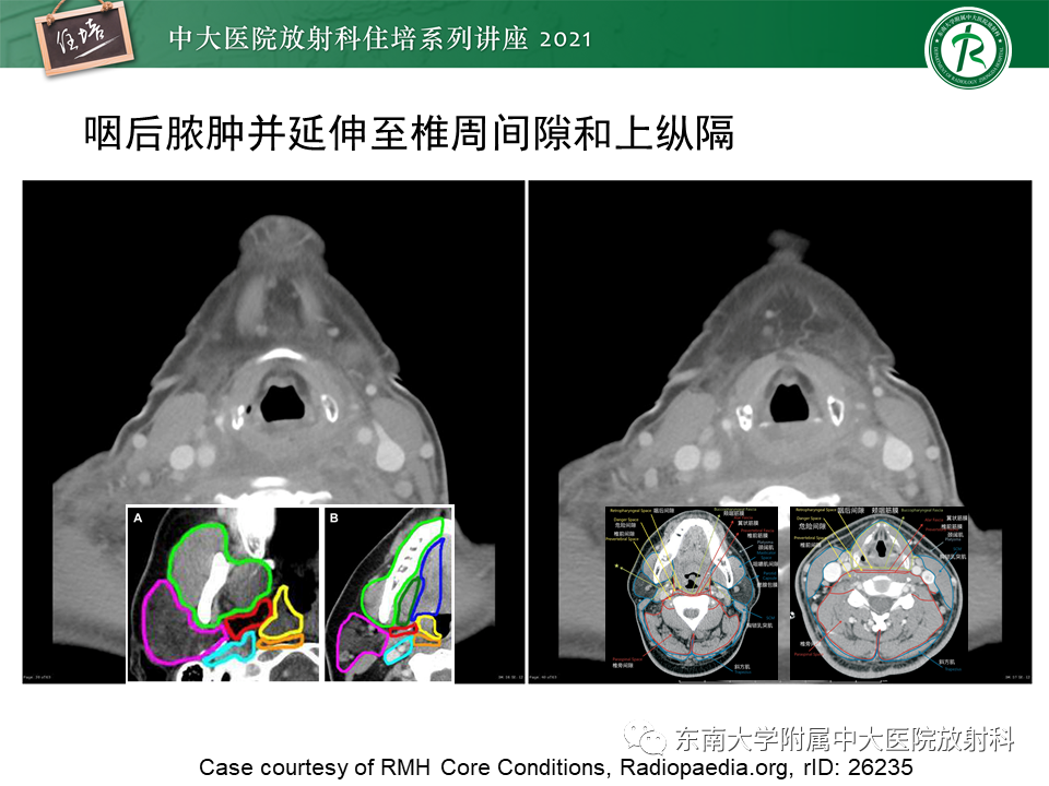 影像PPT - 【PPT】颈部感染的影像诊断及蔓延途径-45